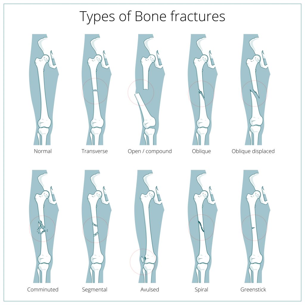 Types Of Bone Fractures Chart