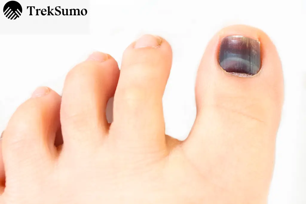 image of a hiker's black toenail